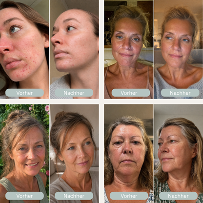 SkinBooster™ - LED Gesichtsmaske